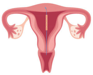 kupferkette gynefix