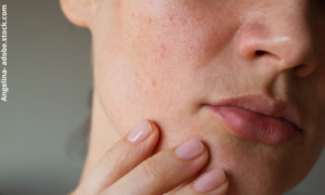 Hautveränderungen und -verschlechterungen können nach Absetzen der Pille auftreten, da die Pille sich häufig positiv auf das Hautbild auswirkt.