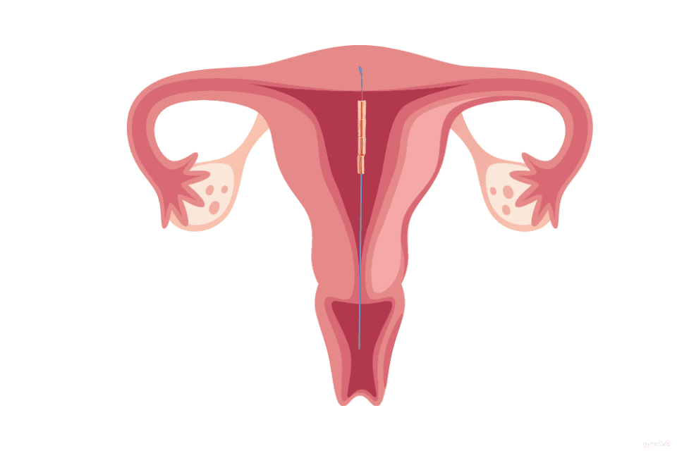 Kupferkette GyneFIX® im Uterus, der Faden ragt in die Scheide.