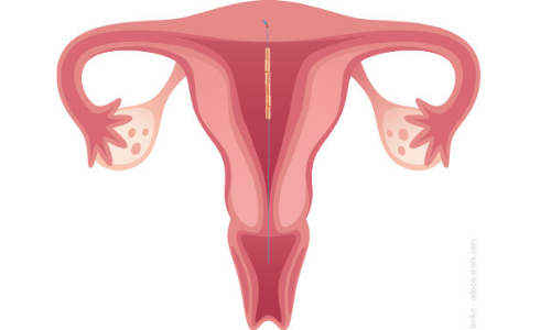 GyneFIX10 Uterus Alternative zur Sterilisation
