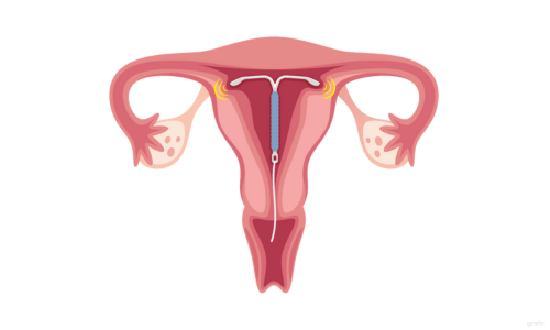 grafik von gynefix klassische kupferspirale druckpunkte und schmerzen