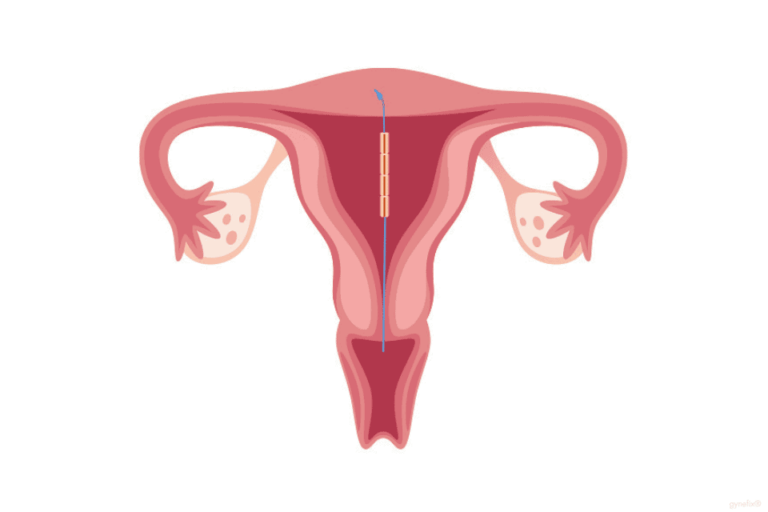 grafik kupferkette gynefix im uterus ist nicht bemerkbar beim sport
