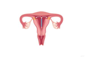 grafik erstellt von gynefix zeigt klassische kupferspirale zu groß eingesetzt macht schmerzen