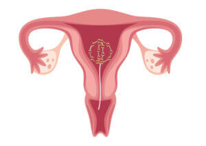 grafik kupferperlenball im uterus