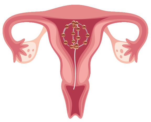 kupferperlenball im uterus