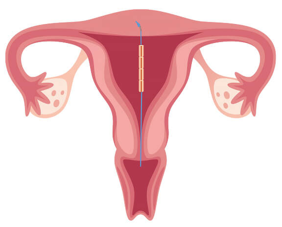 befestigung der kupferkette gynefix