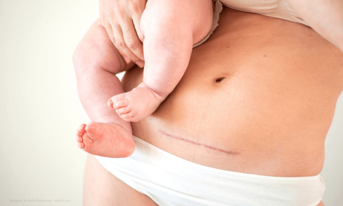 Mutter hält Kind im Arm und hat eine sichtbare Narbe vom Kaiserschnitt auf dem Bauch.