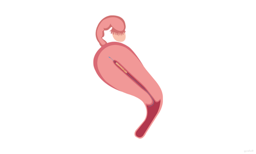 grafik kupferkette gynefix im uterus seitenansicht