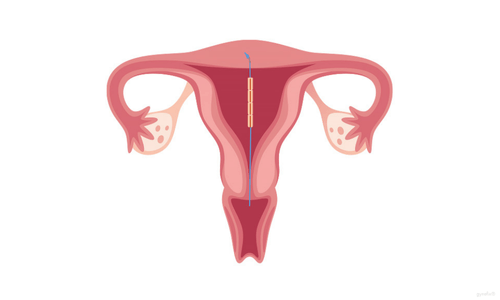 grafik kupferkette gynefix im uterus vorderansicht